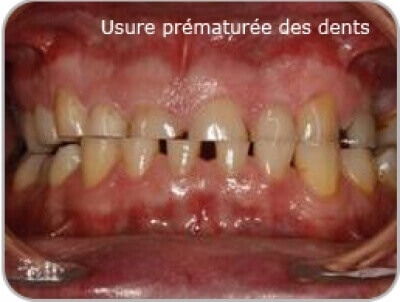 Le grincement des dents : le bruxisme